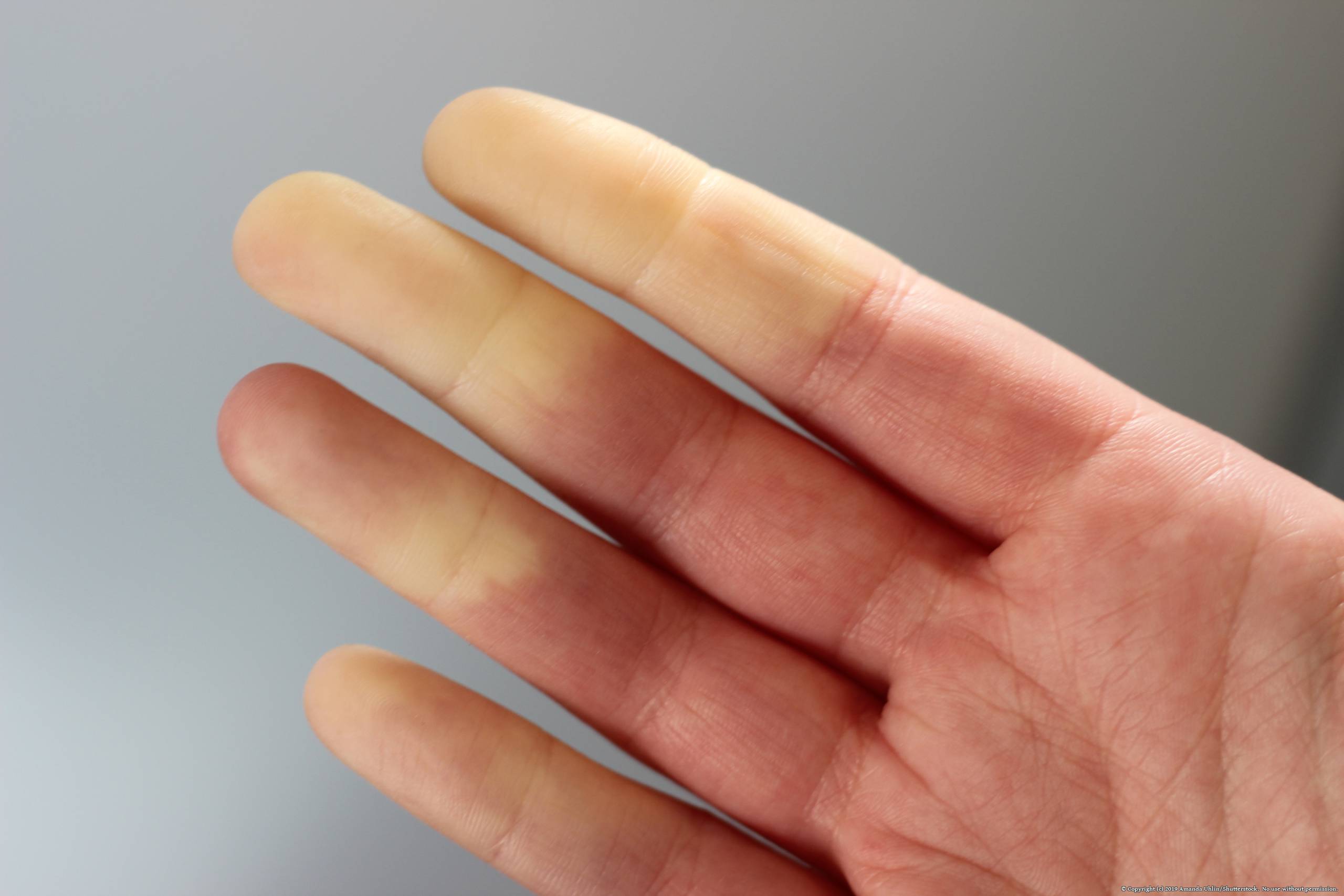 Medical,Picture,Of,A,Women,Hand,With,Raynaulds,Syndrome.